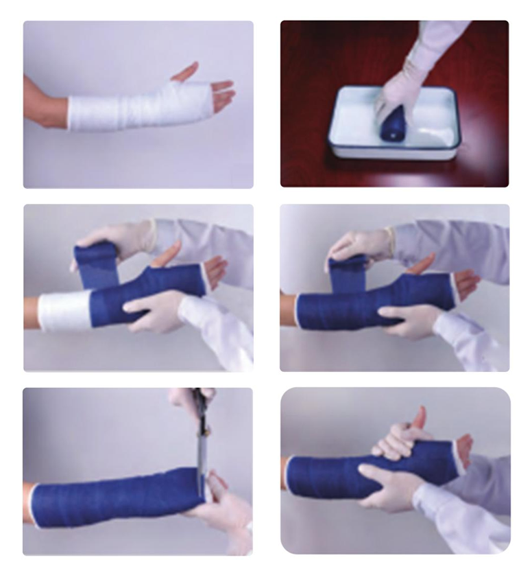 Mga hakbang para sa paggamit ng Orthopedic Casting Tape